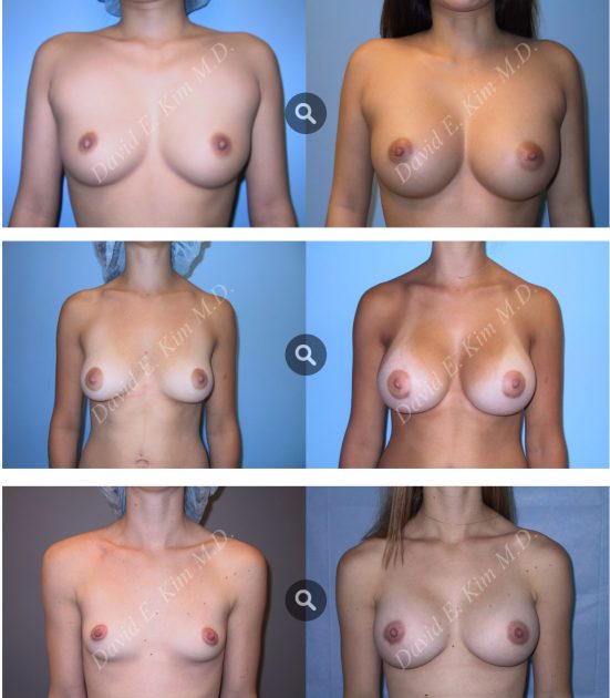Breast Augmentation Plastic Surgery Before And After Photos, Beverly Hills Plastic Surgery