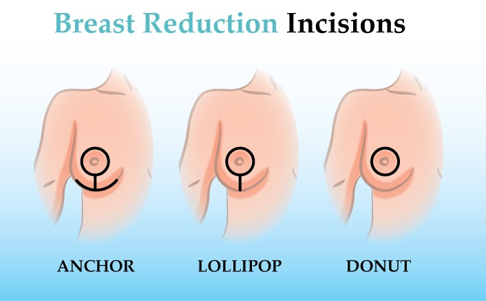 Breast Reduction, Beverly Hills Plastic Surgery