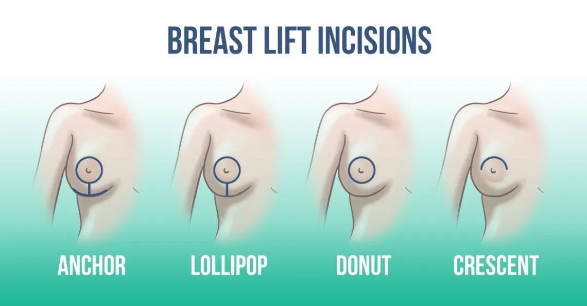 Breast Lift, Beverly Hills Plastic Surgery