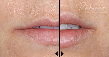 Restylane Dermal Filler Before And After Photos, Beverly Hills Plastic Surgery