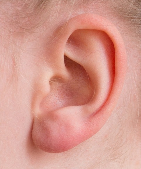 How Much Does Otoplasty Ear Surgery Cost?, Beverly Hills Plastic Surgery
