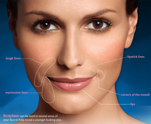 Restylane Dermal Filler, Beverly Hills Plastic Surgery