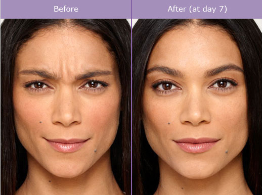 Botox Brow And Forehead Lift, Beverly Hills Plastic Surgery