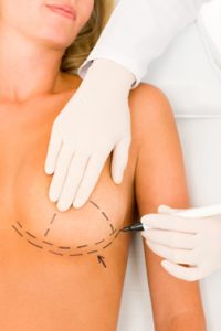 Breast Implant Exchange / Replacement, Beverly Hills Plastic Surgery